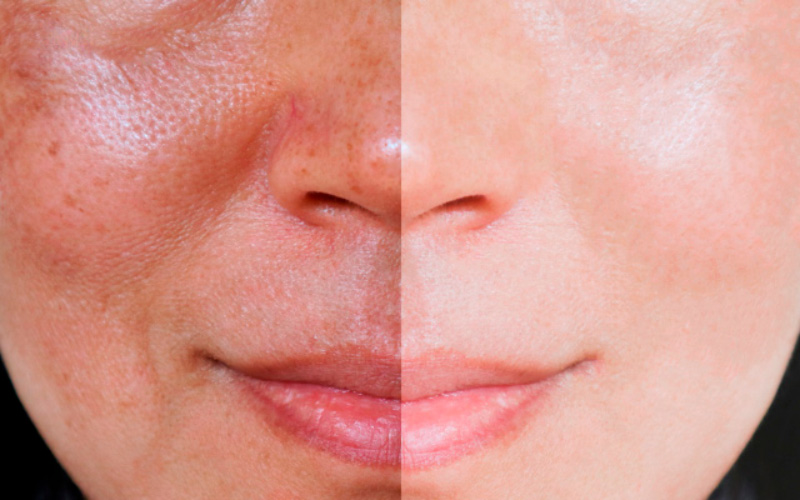 Biorevitalization Peel Work