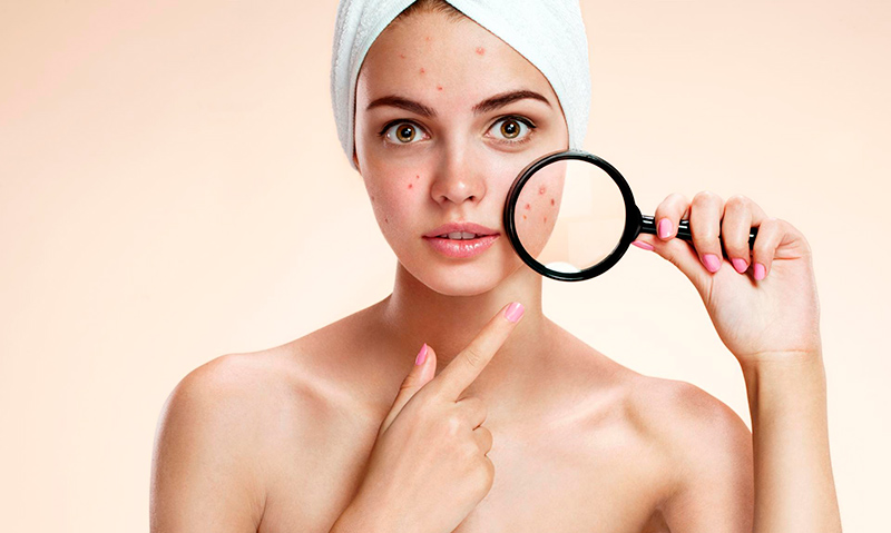 Microdermabrasion and acne
